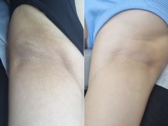 Peeling antes y después - 874443