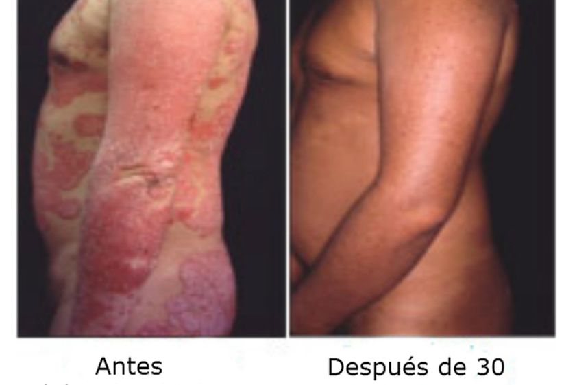 Psoriasis antes y después - 499319