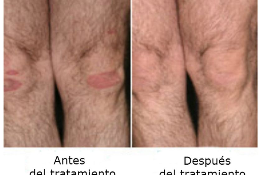 Psoriasis antes y después - 499320