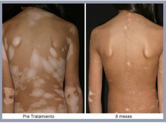 Vitiligo antes y después - 499321