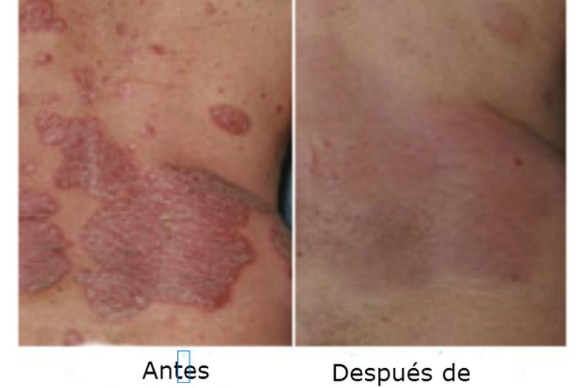 Psoriasis antes y después - 499322