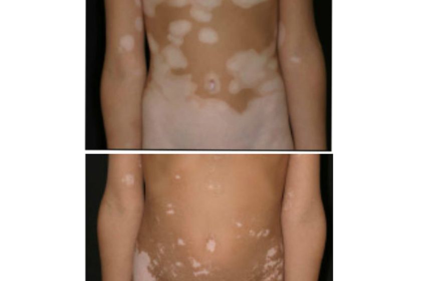 Vitiligo antes y después - 499323