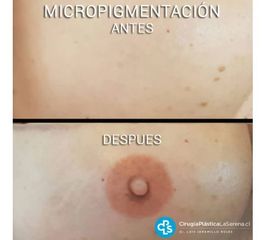Micropigmentacion