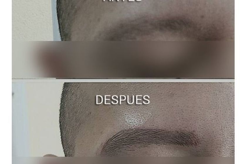 Micropigmentación antes y después - 650978