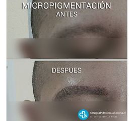Micropigmentación