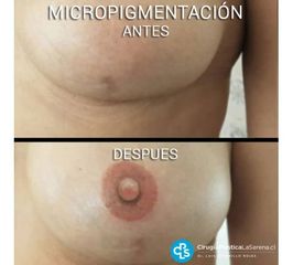 Micropigmentación