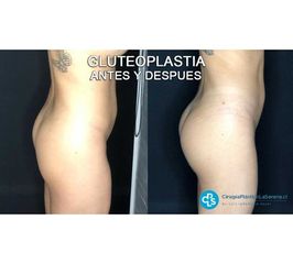Gluteoplastia