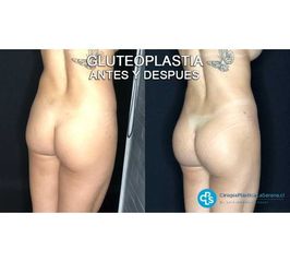Gluteoplastia