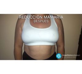 Reducción mamaria