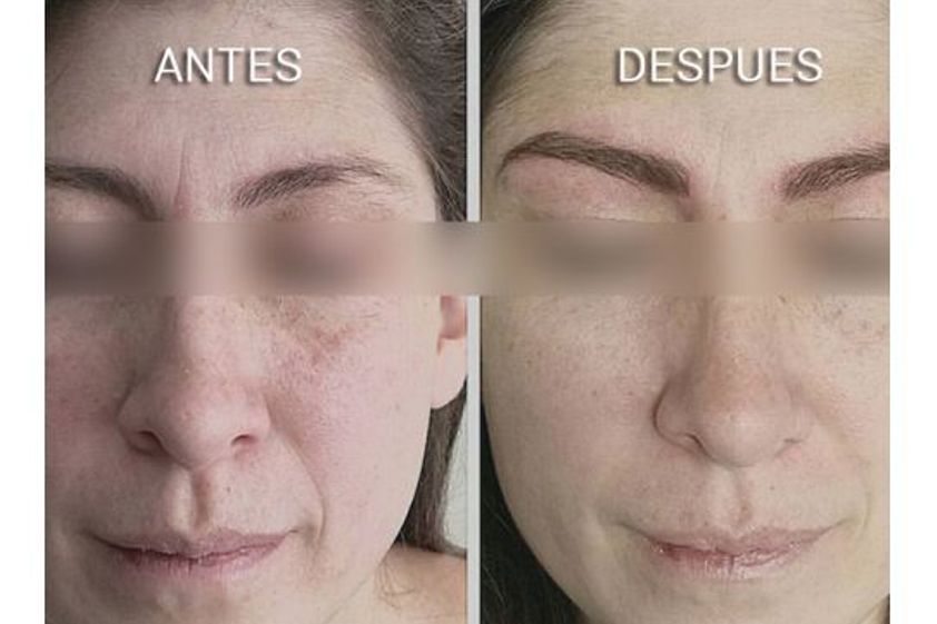 Micropigmentación antes y después - 651002