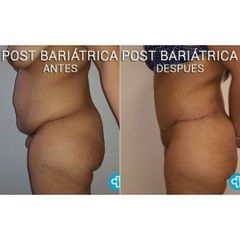 Abdominoplastia Post Bariátrica - Dr. Luis Jaramillo Rojas