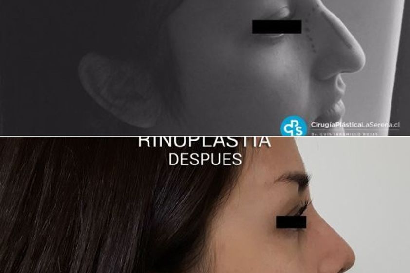 Rinoplastía antes y después - 866884