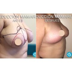 Reduccion Mamaria - Dr. Jaramillo Flores