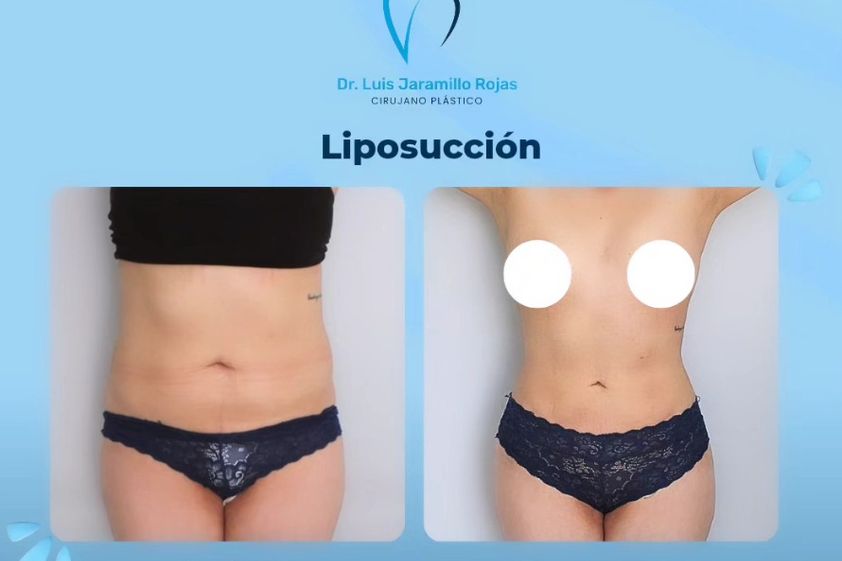 Liposucción antes y después - 866888