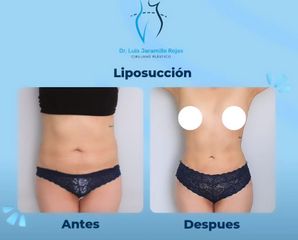 Liposucción - Dr. Luis Jaramillo Rojas
