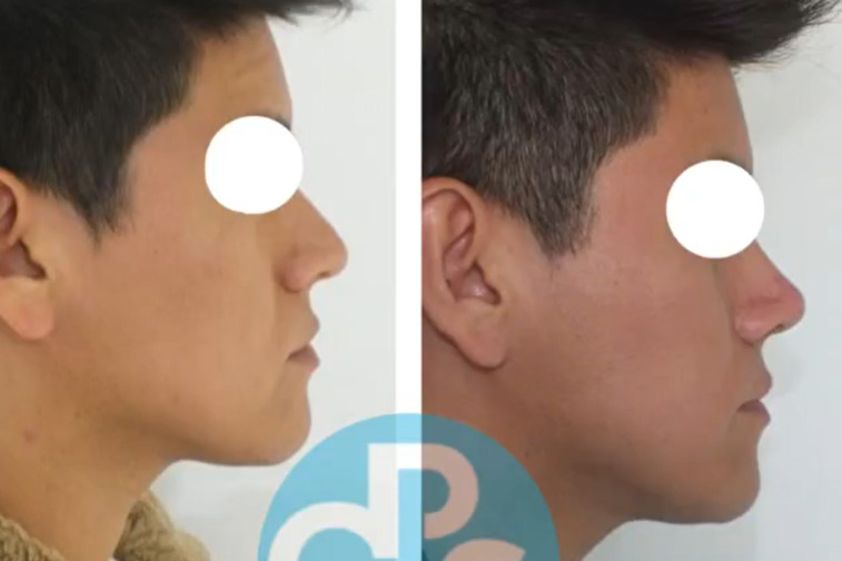 Rinoplastía antes y después - 866890