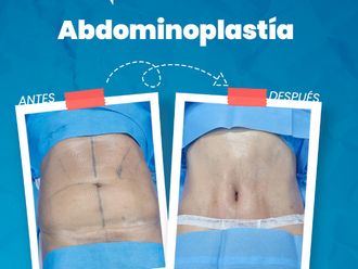 Abdominoplastía antes y después - 866894