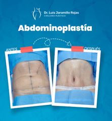 Abdominoplastia  - Dr. Luis Jaramillo Rojas