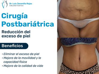 Abdominoplastía antes y después - 866897
