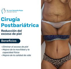 Cirugía Postbariátrica - Dr. Luis Jaramillo Rojas