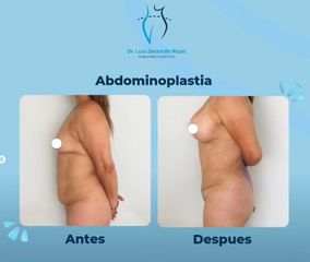Abdominoplastia + Implantes Mamario  - Dr. Luis Jaramillo Rojas