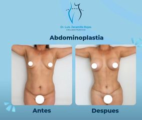 Cirugía combinada Abdominoplastia + Implantes Mamarios- Dr. Luis Jaramillo Rojas