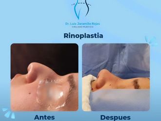 Rinoplastía antes y después - 866900