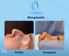 Rinoplastia - Dr. Luis Jaramillo Rojas