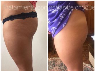 Eliminar las estrías antes y después - 623255