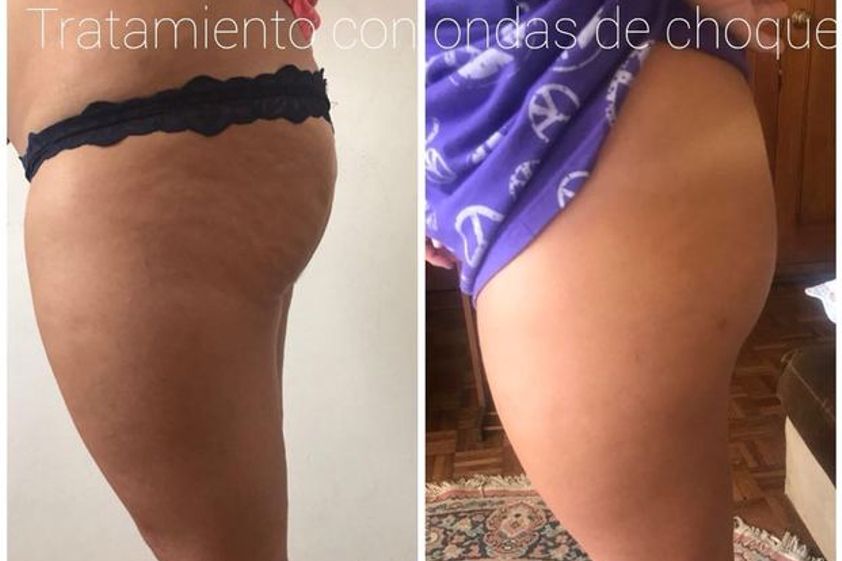 Eliminar las estrías antes y después - 623255