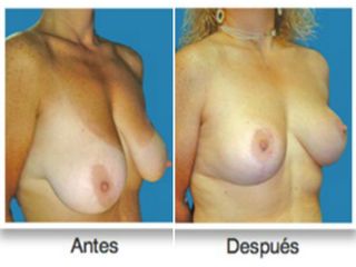 Mastopexia