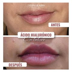 Aumento de labios - Dermalato Dra. Jimena Latorre