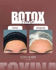 Bótox - Dermalato Dra. Jimena Latorre