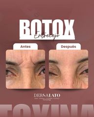Bótox - Dermalato Dra. Jimena Latorre