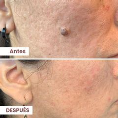 Verrugas - Dermalato Dra. Jimena Latorre