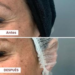 Bótox - Dermalato Dra. Jimena Latorre