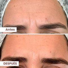 Bótox - Dermalato Dra. Jimena Latorre