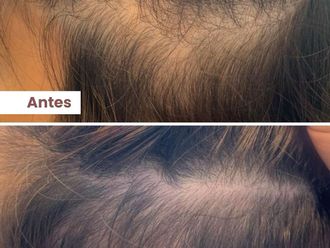 Alopecia antes y después - 860628