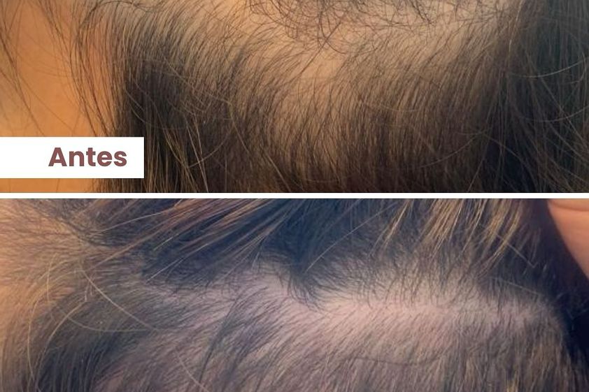 Alopecia antes y después - 860628