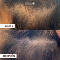 Alopecia - Dermalato Dra. Jimena Latorre