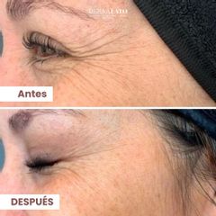 Bótox - Dermalato Dra. Jimena Latorre