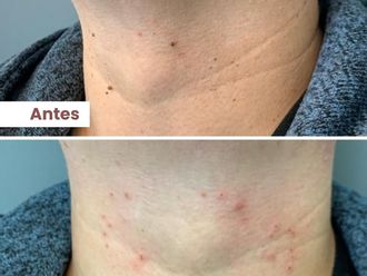 Verrugas antes y después - 860631