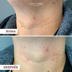 Verrugas - Dermalato Dra. Jimena Latorre