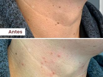 Verrugas antes y después - 860632