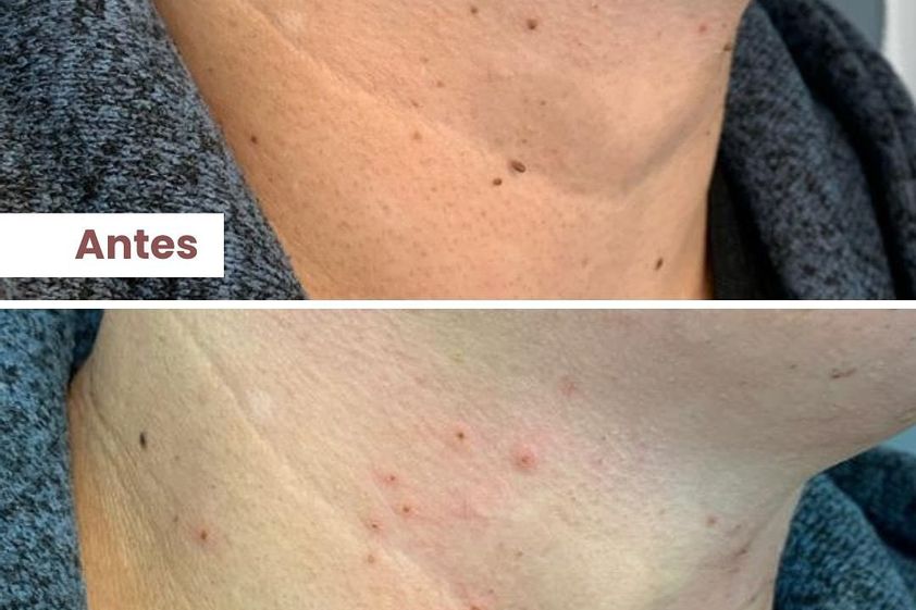 Verrugas antes y después - 860632