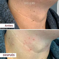 Verrugas - Dermalato Dra. Jimena Latorre