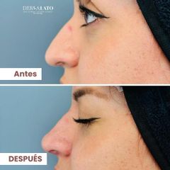 Rinomodelación - Dermalato Dra. Jimena Latorre