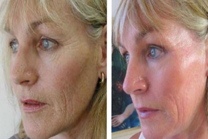 Plasma rico en plaquetas antes y después - 487157