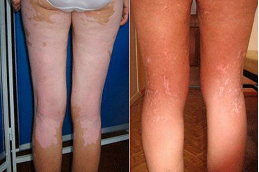 Vitiligo antes y después - 501512