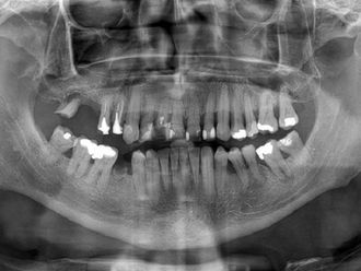 Implantes dentales-648354